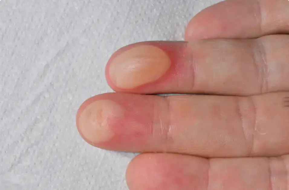 Close-up of blisters on a worker's fingers caused by excessive heat and insufficient hand protection.