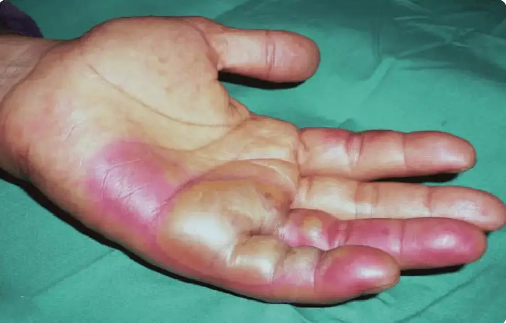 Burn injury with blistering on a worker's palm caused by exposure to excessive heat during welding.